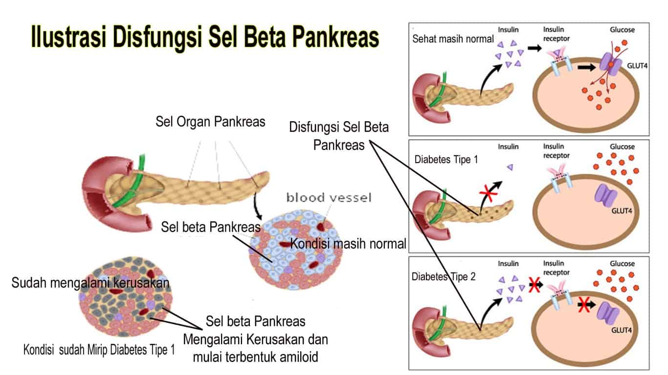 ilustrasi-disfungsi-sel-beta-pankreas