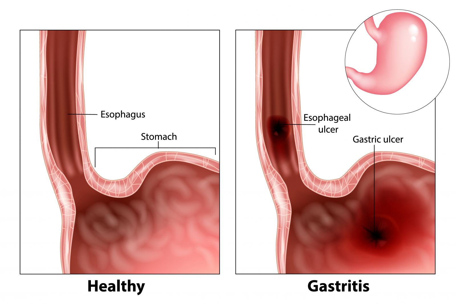 lambung-gastritis