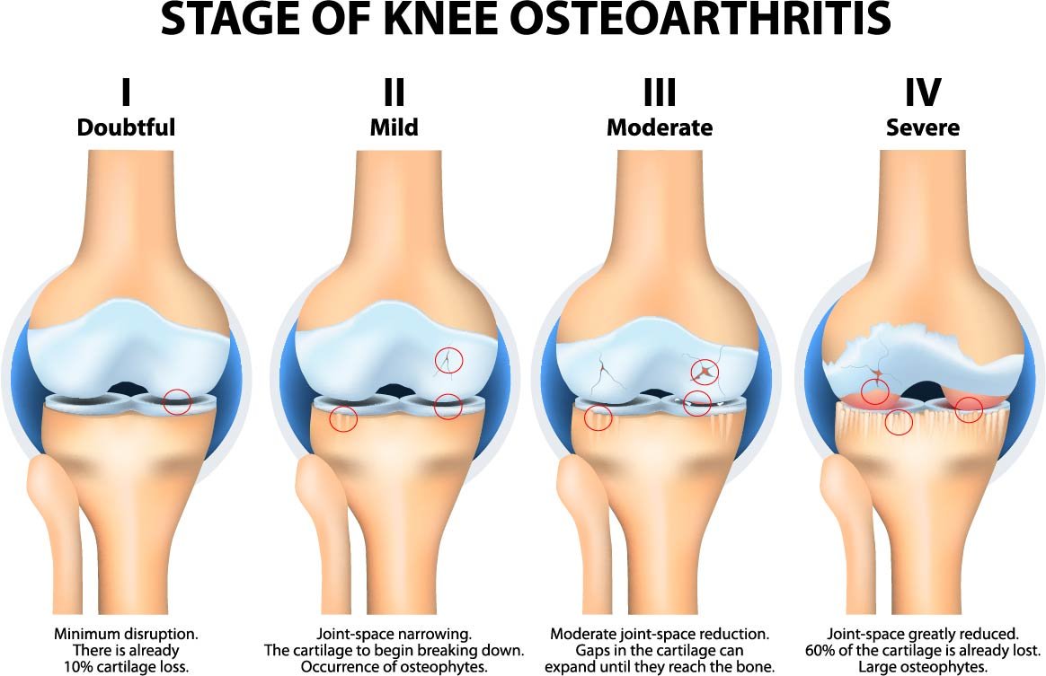 osteoartritis