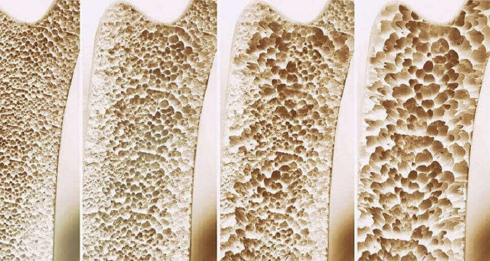 osteoporosis