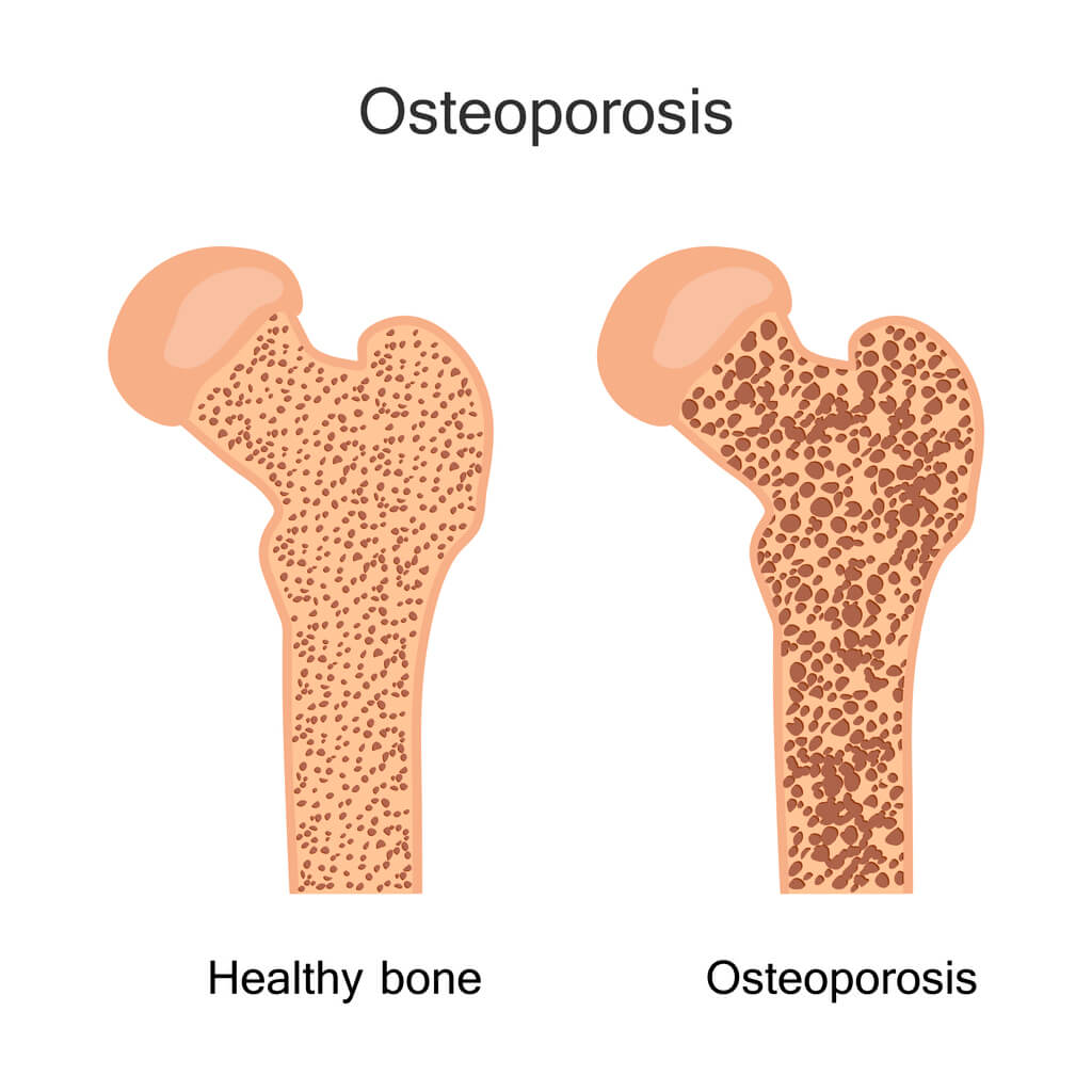 tulang-osteoporosis